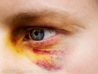 Black eye detail of a woman - purple yellow an...